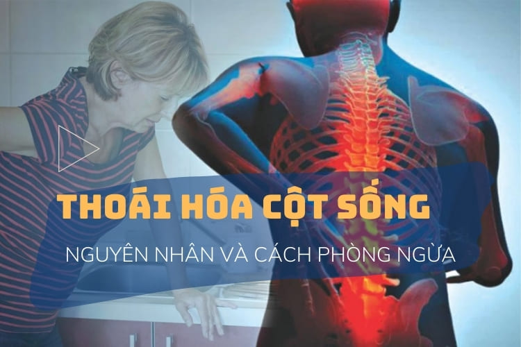 nguyen-nhan-thoai-hoa-cot-song